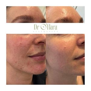 BioRePeel before and after: collage of facial skin close-ups showing results, with the Dr O'Hara logo