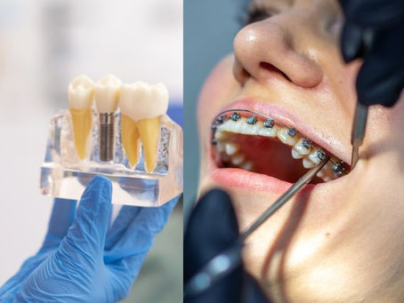 Dental Implants vs. Braces: What to Choose for a Perfect Smile
