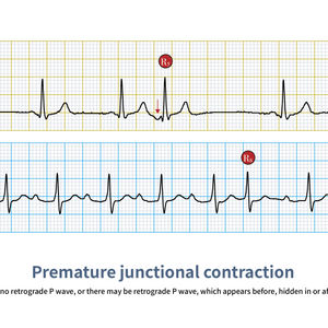EKG rhythm
