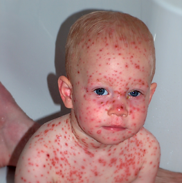 Varicella.png