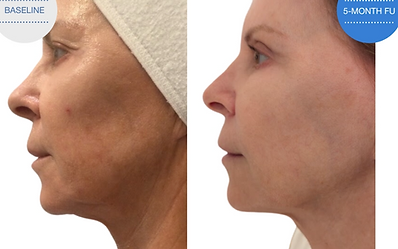 Before/After