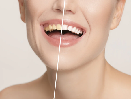 Best Teeth Whitening in Dubai for Daily Bright Smile Enhancement