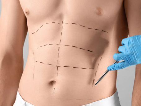 Tummy Tuck in Dubai for a Harmonious and Streamlined Figure