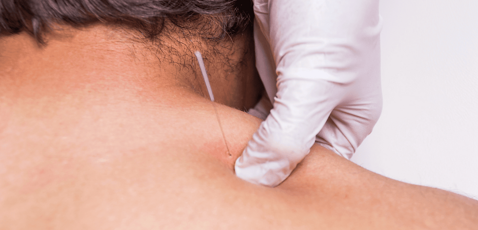 Dry needling applied to the neck area, targeting muscle pain, tension, and discomfort.