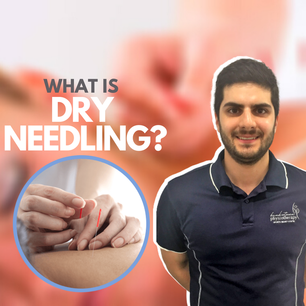 What is Dry Needling?