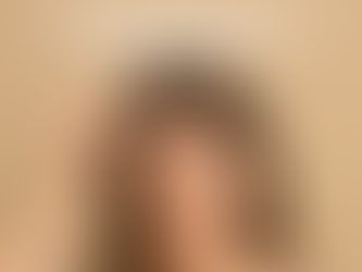 Alopecia androgenetica femminile