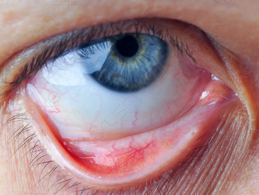 Mitos vs Realidades de los lentes de contacto.