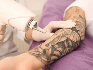 Tatouage de camouflage réaction des pigments au laser