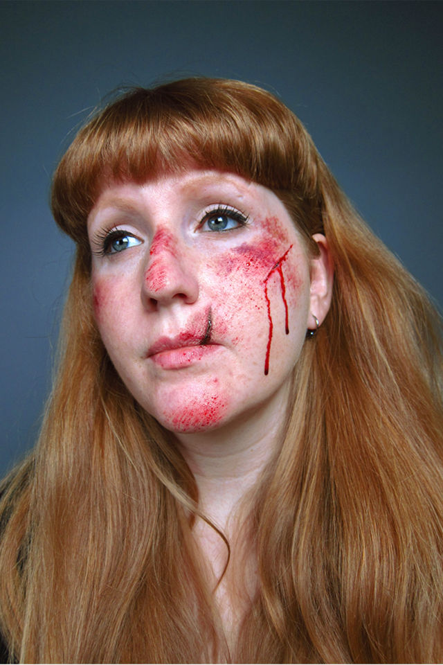 injury