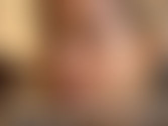 Rejuvenate Your Skin and Erase Fine Lines with Dermapen – See the Stunning Results!