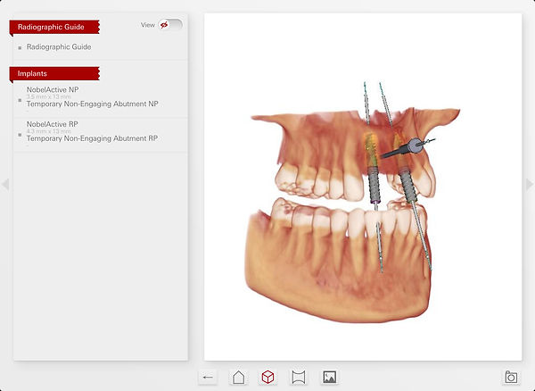 planejamento implantes dentários com NobelClinician