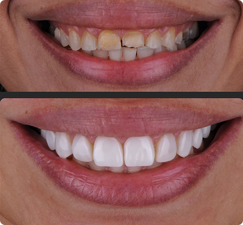 facetas em resina
facetas dentárias estéticas
facetas para dentes
facetas em resina preço
facetas dentais rápidas
facetas dentárias para correção Facetas em resina, facetas dentárias rápidas e naturais, restauração estética em resina, tratamento odontológico estético, sorriso harmonioso com resina
