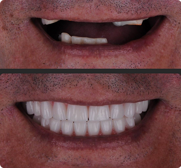 Solução fixa sobre implantes, indicada para reabilitar com conforto, segurança e estética quem perdeu todos os dentes da arcada superior. Com design preciso e materiais de alta qualidade, oferece excelente estabilidade, naturalidade no sorriso e liberdade para falar e se alimentar com confiança. Uma transformação completa, pensada para devolver funcionalidade, bem-estar e autoestima.