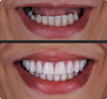 Prótese protocolo superior, prótese fixa sobre implantes, reabilitação oral fixa superior, prótese dentária de alta qualidade, solução fixa para arcada superior
prótese protocolo superior
prótese fixa sobre implantes
prótese protocolo superior preço
reabilitação oral superior
prótese dentária fixa superior
prótese protocolo clínica odontológica
implantes com prótese protocolo superior
