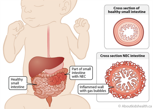 Necrotizing Enterocolitis (NEC)