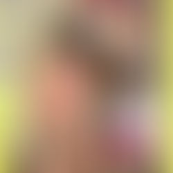 Do You Want Freckles?