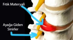 Bel Ağrısı Nedir yazı görseli