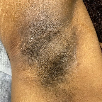 Silky smooth skin after professional underarm waxing at East Falls Waxing Salon