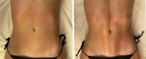 Antes e Depois Miracle Touch by Dra Angelica Garcez.jpg