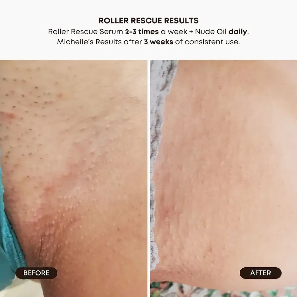 Thumbnail: Ingrown Hair Oil