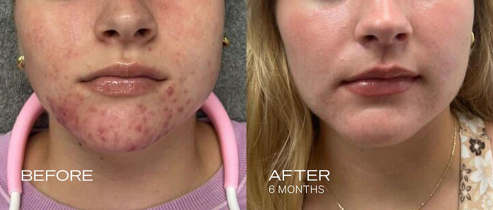 Side-by-side before-and-after close-up of a woman’s chin: acne on the left, clearer skin on the right. Text: BEFORE, AFTER 6 MONTHS