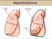 Ensayos clínicos en Europa dan esperanzas a la cura del Mesotelioma