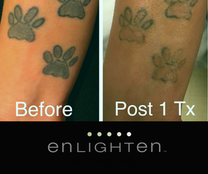 Treat Your Tattoo Removal Process Well