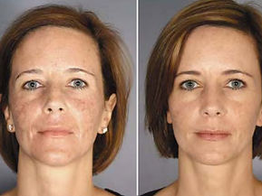 Erbium YAG Laser Facial