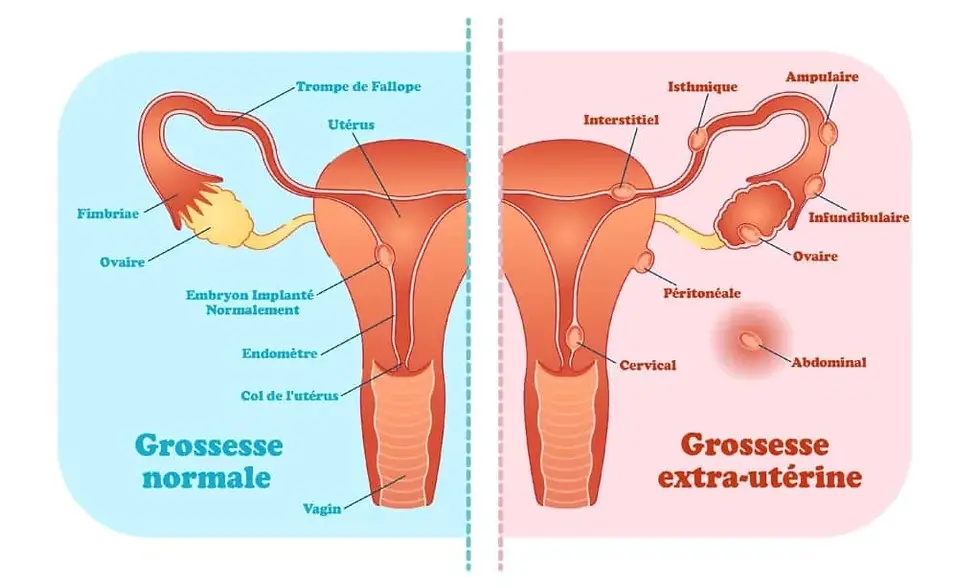 grossesse extra utérine