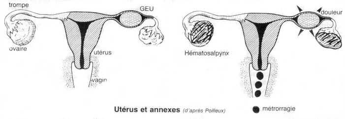 grossesse extra utérine