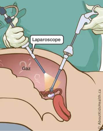 grossesse extra utérine