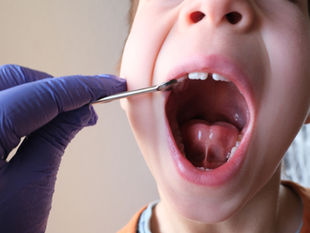 A PARENT'S GUIDE TO TONGUE TIES