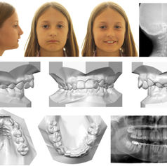 UNDERSTANDING CONDYLAR RESORPTION