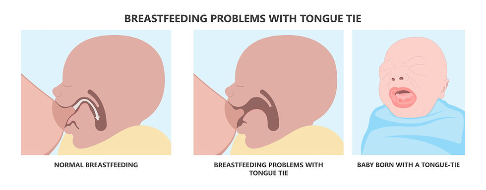 tongue ties can impact breast feeding