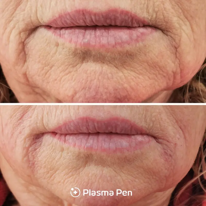 Plasma Pen jowls before and after