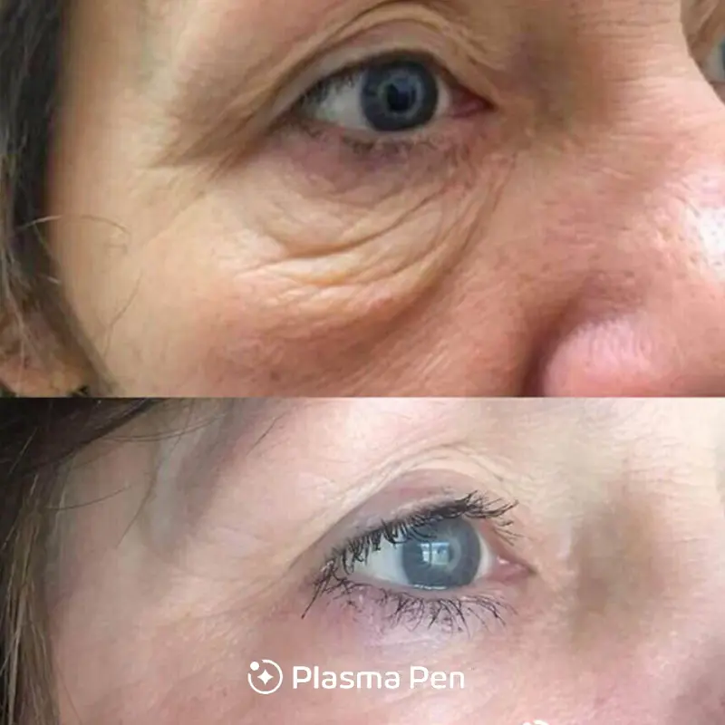 Plasma Pen under eyes before and after