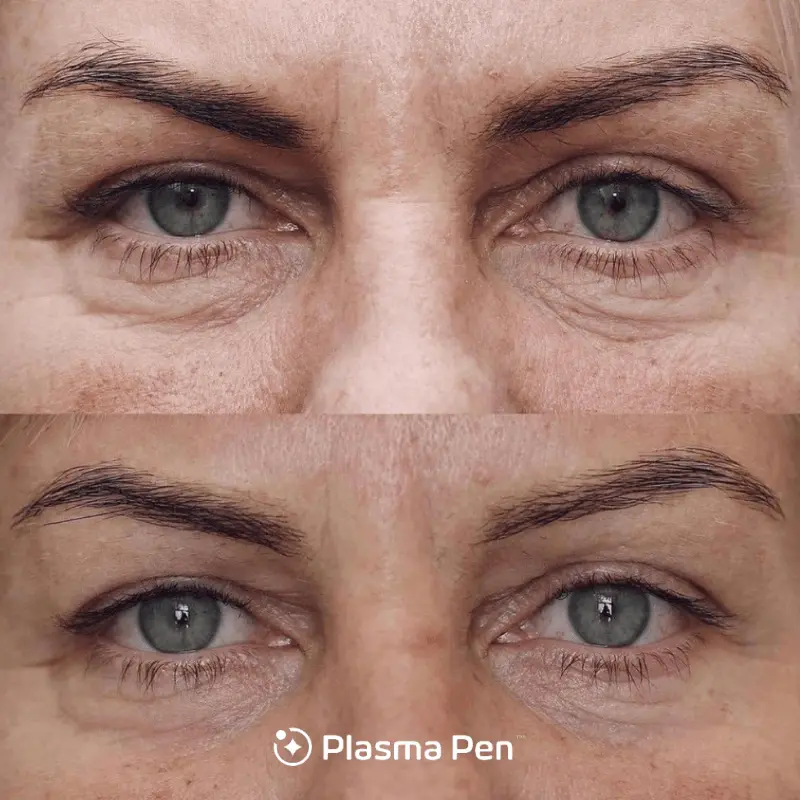 Plasma Pen under eyes before and after