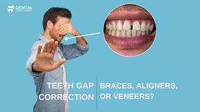 Teeth Gap Correction in Bangalore – Braces, Aligners, or Veneers?