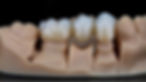Dental Bridges - Dental Sanctuary, Bangalore
