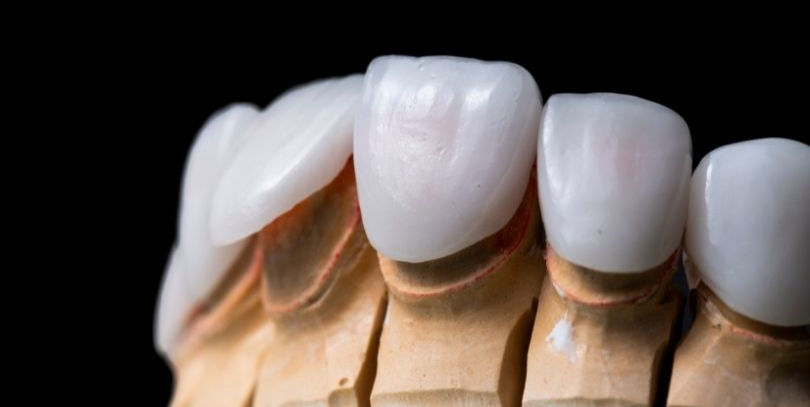 Dental Veneers - Dental Sanctuary, Bangalore