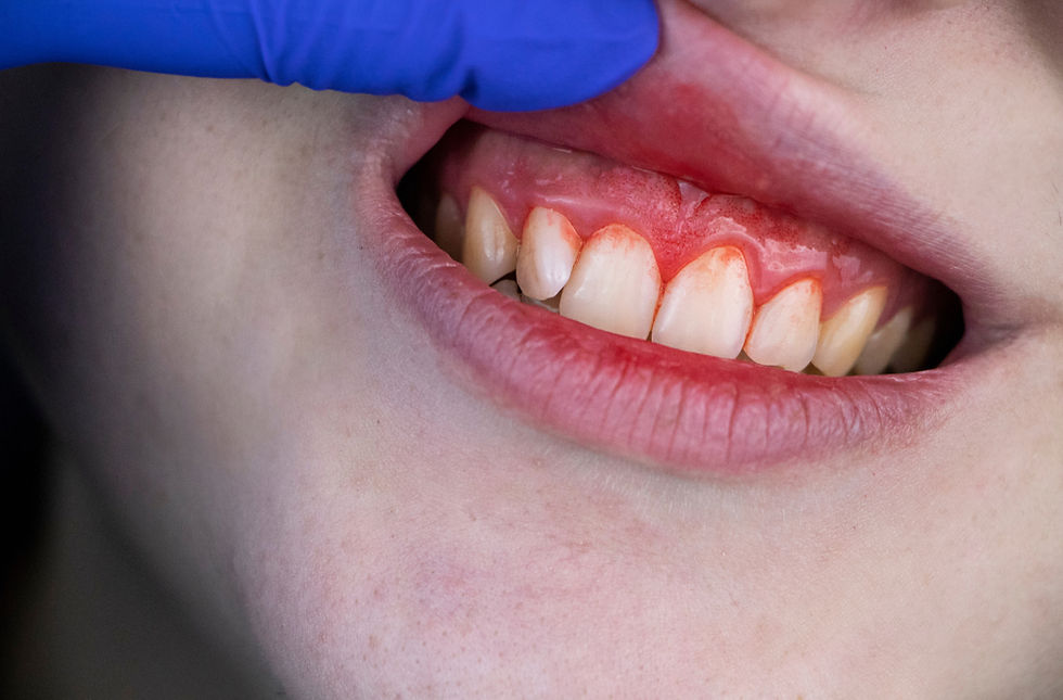 Bleeding gums