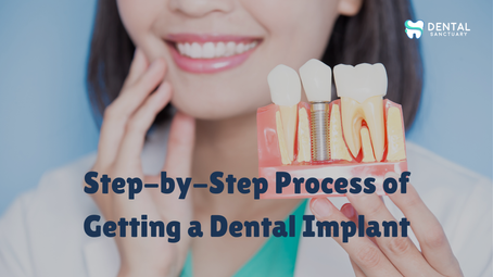 Step-by-Step Process of Getting a Dental Implant