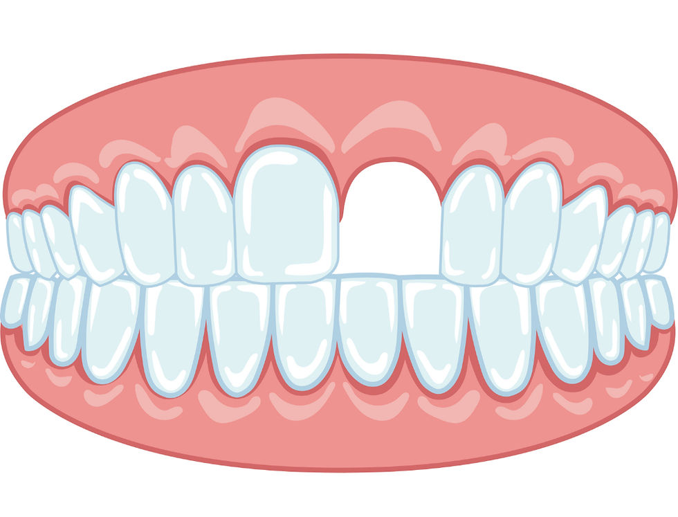 Missing tooth - Dental Sanctuary, Bangalore