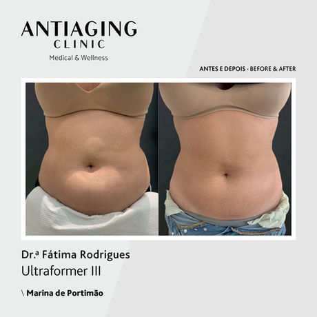 O tratamento com ULTRAFORMER III® tem indicação para:
Rugas, flacidez, firmeza muscular, a gordura localizada e o envelhecimento da pele, tanto na face, como no corpo.
É um tratamento médico seguro e eficaz para gordura localizada, firmeza muscular e rejuvenescimento da pele do rosto, pescoço, decote, abdómen, glúteos, peito, braços, pernas ou vagina.
O ULTRAFORMER III® é um equipamento topo de gama, de ultrassom micro e macro focado, também conhecido por ultrasom focalizado de alta intensidade (HIFU - High Intensity Focused Ultrasound).
Através da emissão de ondas ultrassónicas que penetram nas camadas mais profundas do tecido muscular da pele, o ULTRAFORMER III® promove a produção natural de colagénio, a tonificação dos tecidos musculares da pele, atenua as rugas e proporciona um efeito lifting imediato.