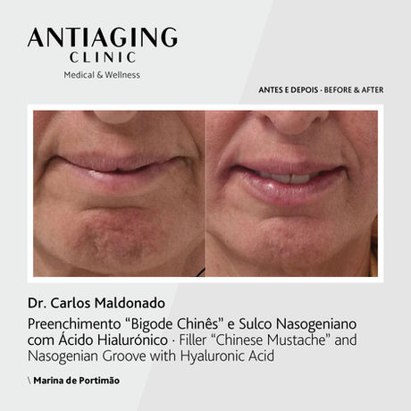 Os preenchimentos com ácido hialurónico aliviam as rugas, mantendo a sua expressão natural.
Temos disponível ácido hialurónico específico para rugas finas, outros para rugas profundas, outros para lábios, outros para volume, outros ainda apenas para hidratação.
Indicado para prevenir o aparecimento das primeiras linhas de expressão e impedir a formação das rugas profundas.
Preenchimento de sulcos e rugas.
Aumento, Hidratação ou definição de contorno de lábios.
Harmonização facial.
Remodelação do nariz - Rinomodelação.
Remodelação do queixo.
Corrigir assimetrias.
Embelezamento de mãos e pescoço.