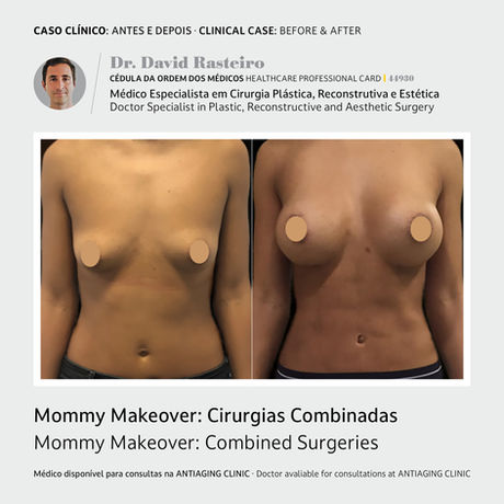 O Mommy Makeover consiste num conjunto de procedimentos de cirurgia plástica destinados a restaurar as formas do corpo que a mulher tinha antes da gravidez e que fruto do processo de maternidade.

Durante a gravidez e no pós-parto, o corpo da mulher passa por alterações que podem ser incómodas.

O Mommy Makeover visa ajudar a mulher a recuperar a feminilidade e autoestima perdidas durante este processo.

Na área mamária, há uma perda do volume da mama devido ao período de amamentação e, por vezes, um excesso de pele, resultando numa mama mais descaída ou com atrofia da glândula mamária.

Na região abdominal, surgem sinais de flacidez, excesso de pele e estrias.

Remoção de pele solta e recuperação da firmeza abdominal.

Remoção de gordura em excesso para alcançar um corpo mais definido – abdómen, costas, coxas ou braços.

O Mommy Makeover envolve intervenções de contorno corporal como:

Lipoabdominoplastia com lipoaspiração circunferencial. 

Cirurgia mamária (lifting mamário ou mamoplastia de aumento ou redução).