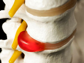 All About Lumbar Disc Prolapse