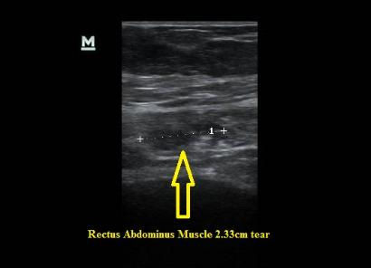 Ultrasound_torn_rectus_abdominus_muscle_NJ_Sports_Medicine.jpg