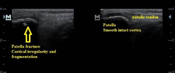 Ultrasound_patella_fracture_distal_pole_NJ_Sports_Medicine.jpg