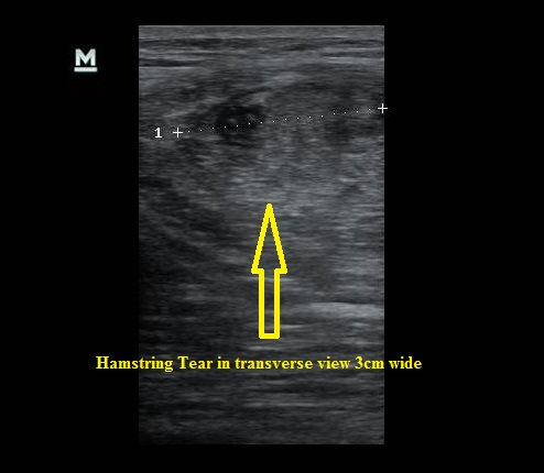 Ultrasound_Hamstring_Tear_Transverse_View_NJ_Sports_Medicine.JPG